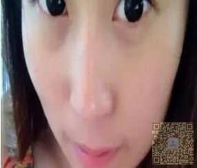 做了超声波去眼袋,不错的效果198 做了超声波去眼袋,不错的效果198