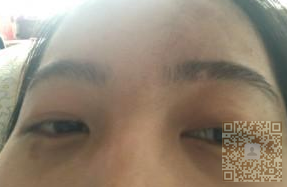 做了超声波去眼袋,不错的效果198 做了超声波去眼袋,不错的效果198