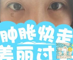 做了超声波去眼袋,不错的效果198 做了超声波去眼袋,不错的效果198