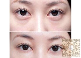 超 声 波祛眼袋还原美少女时代 超 声 波祛眼袋还原美少女时代