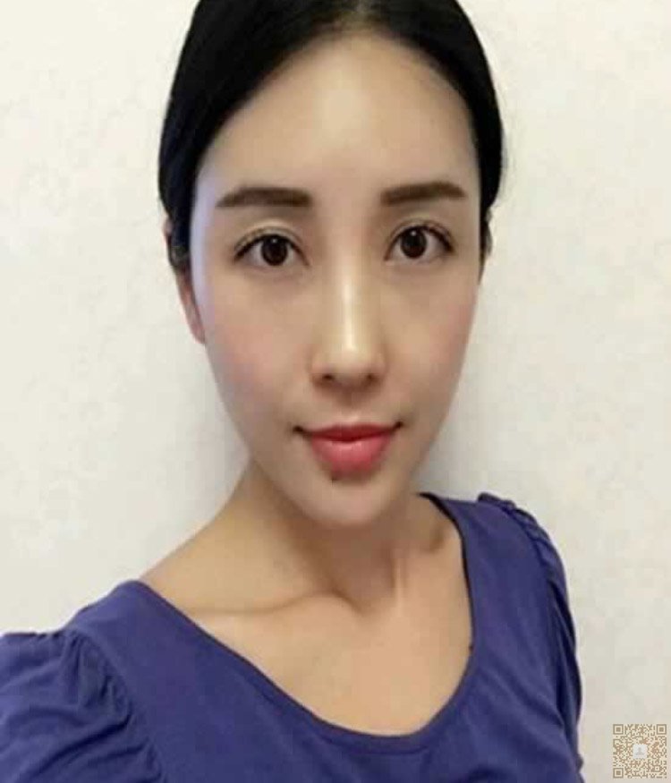 做完超声波去眼袋人显年轻多了541 做完超声波去眼袋人显年轻多了541