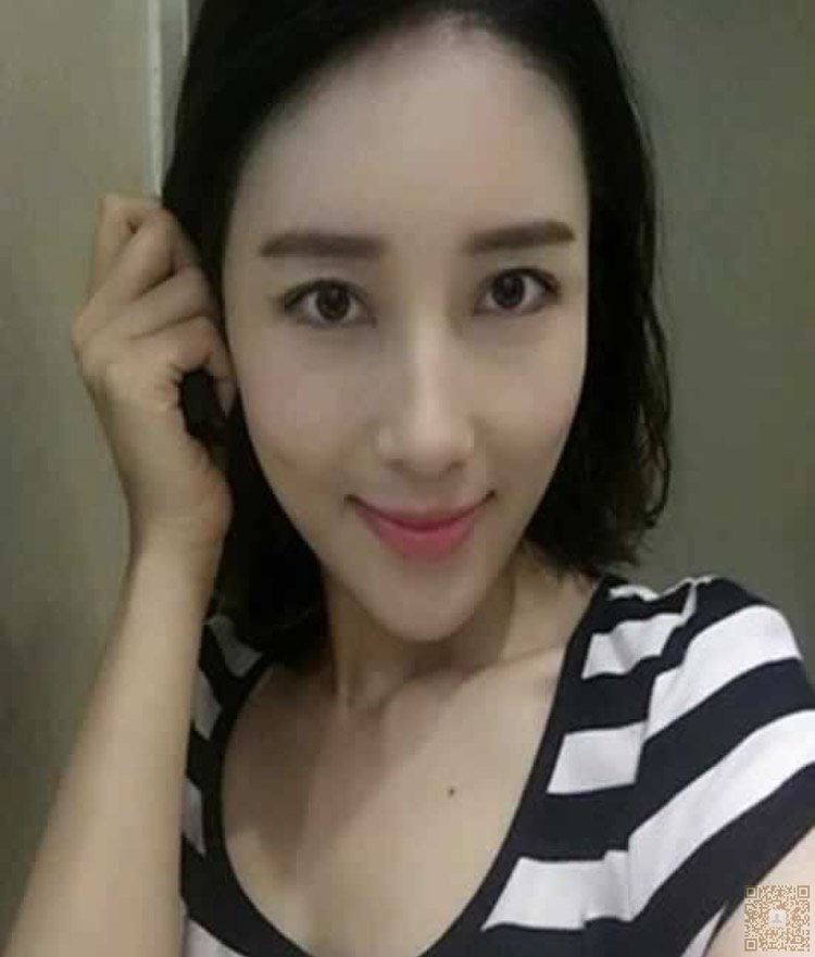 做完超声波去眼袋人显年轻多了541 做完超声波去眼袋人显年轻多了541