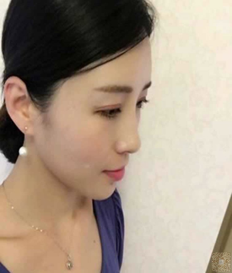 做完超声波去眼袋人显年轻多了541 做完超声波去眼袋人显年轻多了541