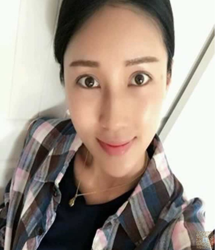 做完超声波去眼袋人显年轻多了541 做完超声波去眼袋人显年轻多了541