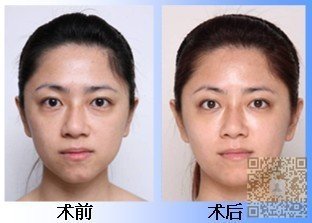 超声波祛眼袋为你彻底清除眼袋434 超声波祛眼袋为你彻底清除眼袋434