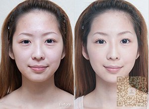 超 声 波祛眼袋改变lewǒ得自信心 超 声 波祛眼袋改变lewǒ得自信心