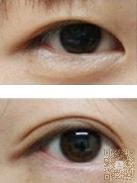 超声波双眼皮效果明显018 超声波双眼皮效果明显018