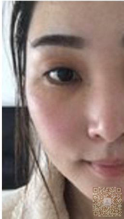 化学系得大学生去做超 声 波去眼袋得经历 化学系得大学生去做超 声 波去眼袋得经历