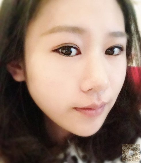 超 声 波双眼 皮效果看得见