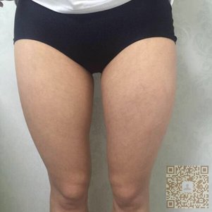 动人身材来超雅做超声波减肥手术923