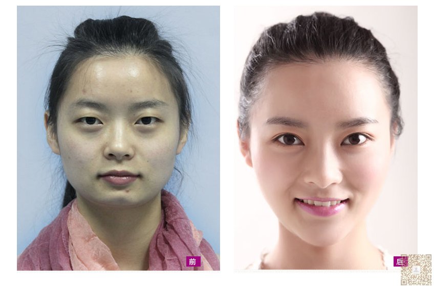超 声 波去眼袋,没有让wǒ失望 超 声 波去眼袋,没有让wǒ失望