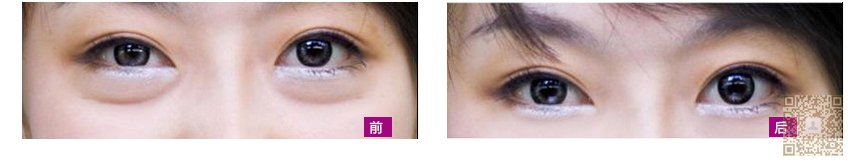 超 声 波去眼袋,没有让wǒ失望 超 声 波去眼袋,没有让wǒ失望