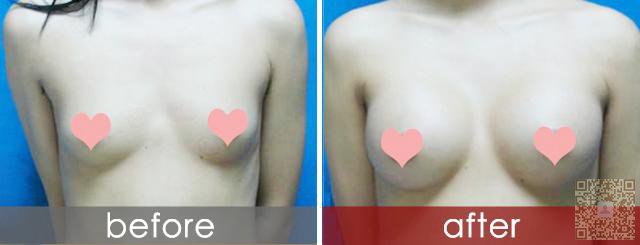 超声波自体脂肪丰胸让我挤入丰满女行列啦，嘻嘻384
