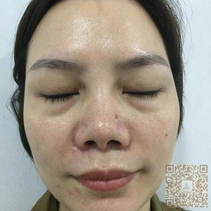 超 声 波去眼袋手术术后不复发 超 声 波去眼袋手术术后不复发