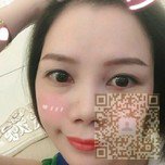 超 声 波去眼袋手术术后不复发 超 声 波去眼袋手术术后不复发