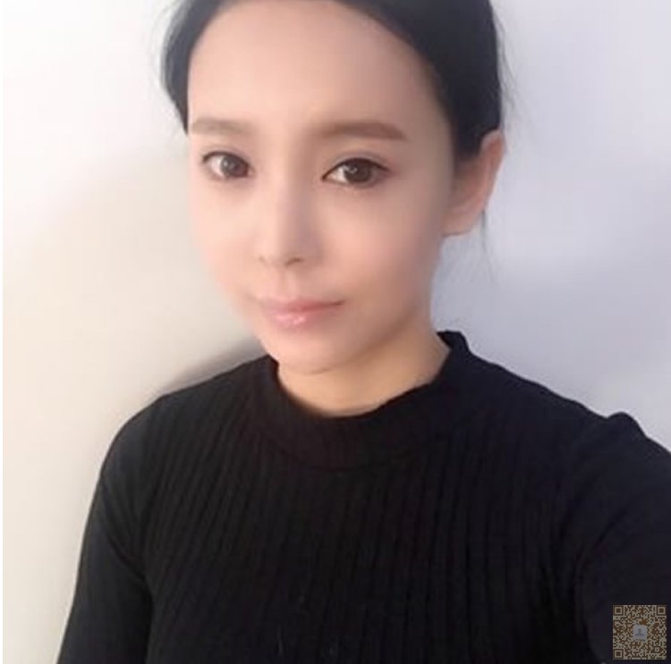 和朋友一起做了超声波祛眼袋,一起变漂亮576 和朋友一起做了超声波祛眼袋,一起变漂亮576