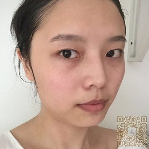 超声波双眼皮给我桃花眼319 超声波双眼皮给我桃花眼319