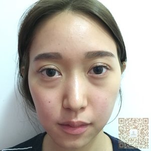 超 声 波去眼袋后wǒ还shì小仙女 超 声 波去眼袋后wǒ还shì小仙女