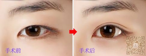 姐妹们我做了超声波双眼皮,看看怎么样啊379 姐妹们我做了超声波双眼皮,看看怎么样啊379