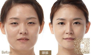 我的超声波双眼皮之路324 我的超声波双眼皮之路324