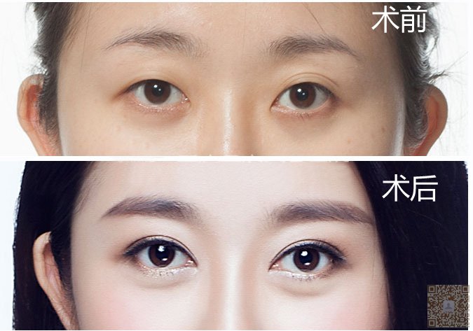 我的超声波双眼皮之路324 我的超声波双眼皮之路324