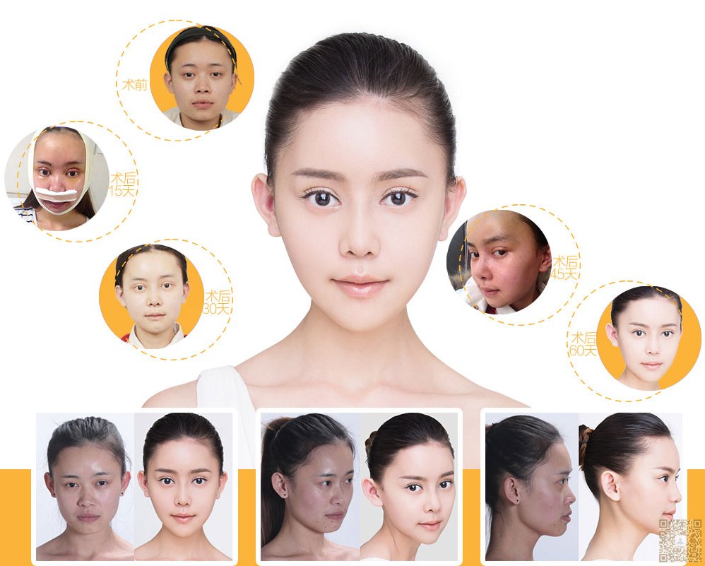 我的超声波双眼皮之路324 我的超声波双眼皮之路324
