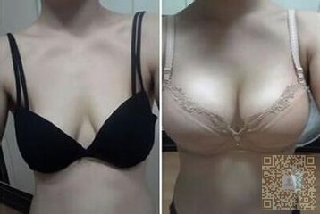 超 声 波丰胸手术让wǒ得到le自信 超 声 波丰胸手术让wǒ得到le自信