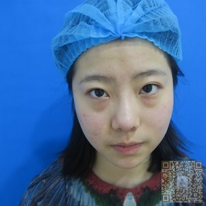 要年轻就来做超雅超 声 波去眼袋 要年轻就来做超雅超 声 波去眼袋