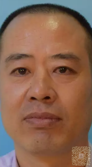 王大叔得祛眼袋日记 王大叔得祛眼袋日记