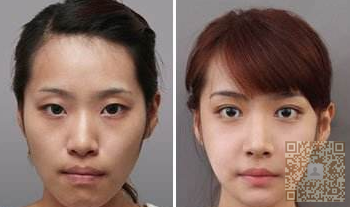 做了超声波双眼皮很久了,跟大家聊聊吧655 做了超声波双眼皮很久了,跟大家聊聊吧655