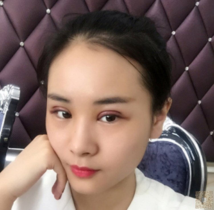 超 声 波双眼 皮让你得眼睛更大更迷人 超 声 波双眼 皮让你得眼睛更大更迷人