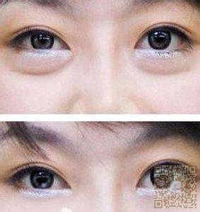 超雅美容院的超声波去眼袋效果好686 超雅美容院的超声波去眼袋效果好686