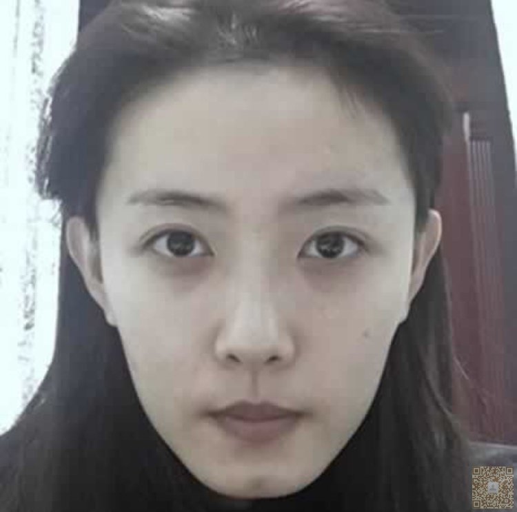 我就佩服超声波双眼皮的效果186 我就佩服超声波双眼皮的效果186