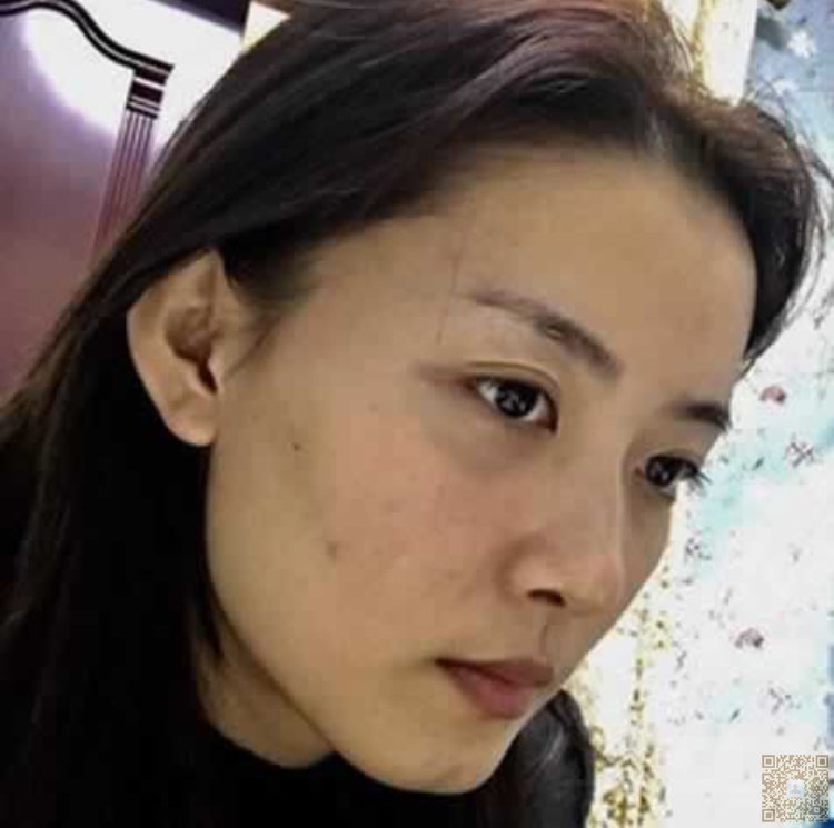 我就佩服超声波双眼皮的效果186 我就佩服超声波双眼皮的效果186