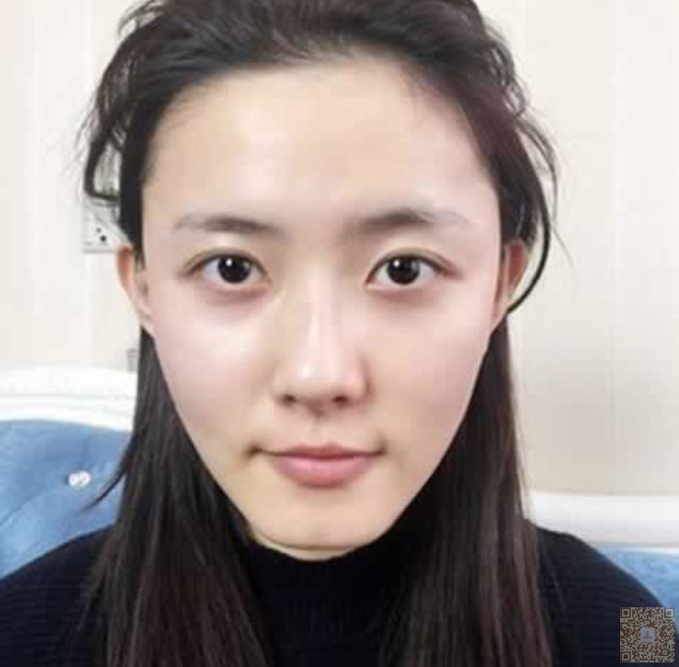 我就佩服超声波双眼皮的效果186 我就佩服超声波双眼皮的效果186