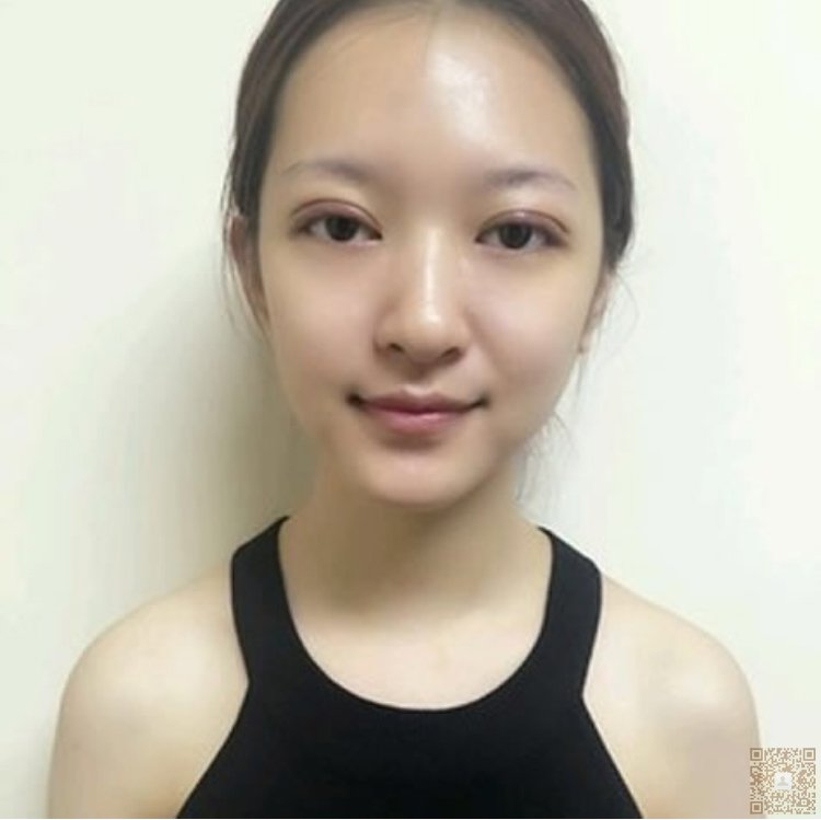 超 声 波双眼 皮让你摆脱眯眯眼 超 声 波双眼 皮让你摆脱眯眯眼
