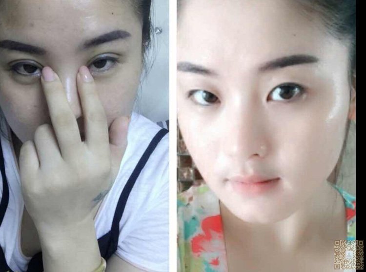 超 声 波双眼 皮果然很好看 超 声 波双眼 皮果然很好看