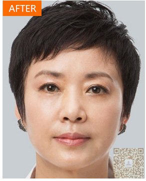 超 声 波祛眼袋使眼睛更明亮 超 声 波祛眼袋使眼睛更明亮