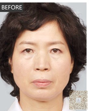 超 声 波祛眼袋使眼睛更明亮 超 声 波祛眼袋使眼睛更明亮