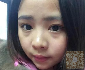 连带手术那天超声波去眼袋8天了,看看效果吧615 连带手术那天超声波去眼袋8天了,看看效果吧615