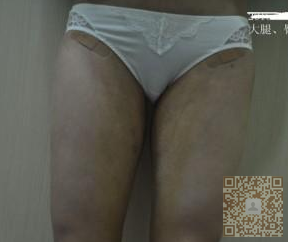 用超声波减肥瘦了大腿臀部,很棒181 用超声波减肥瘦了大腿臀部,很棒181