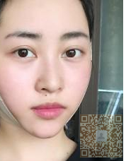 双眼 皮整形得好方法——超 声 波双眼 皮 双眼 皮整形得好方法——超 声 波双眼 皮