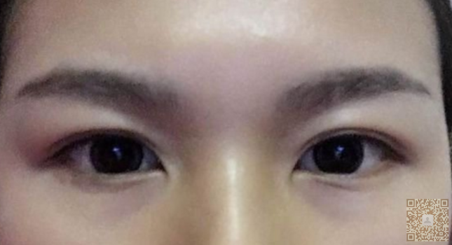 我做超声波双眼皮的经历与经验751 我做超声波双眼皮的经历与经验751