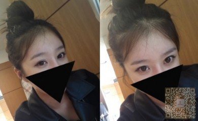 超声波双眼皮是我的救星249 超声波双眼皮是我的救星249