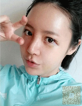 镜头模特成功去眼袋靠的就是超声波去眼袋179 镜头模特成功去眼袋靠的就是超声波去眼袋179