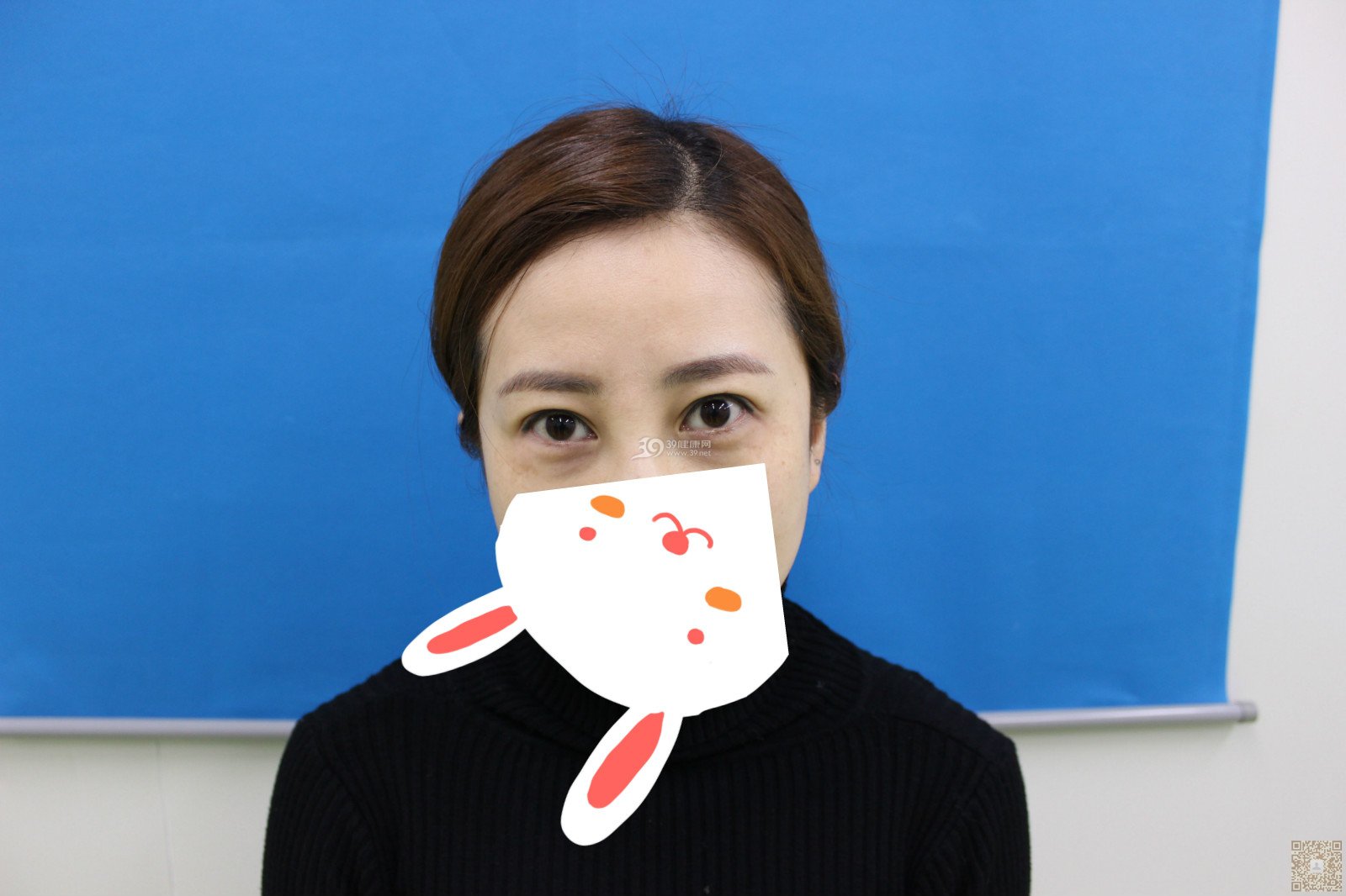 结束3年的眼袋生活只因为我做了超声波去眼袋140 结束3年的眼袋生活只因为我做了超声波去眼袋140