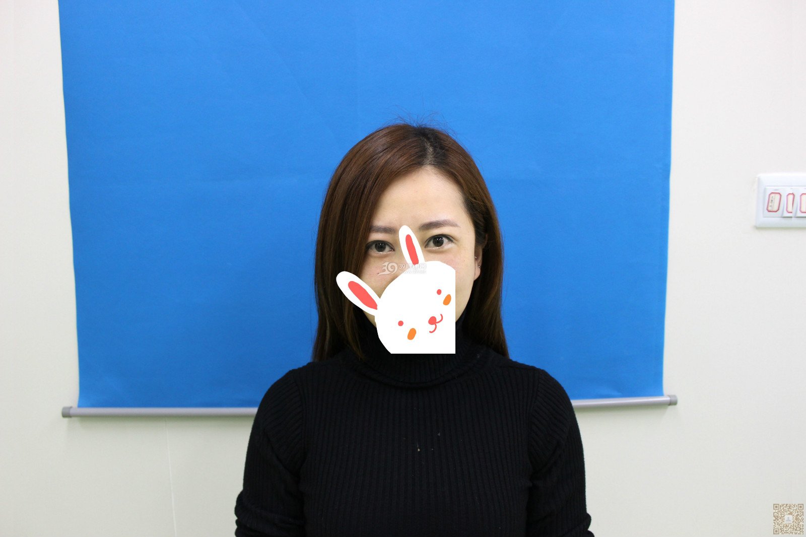 结束3年的眼袋生活只因为我做了超声波去眼袋140 结束3年的眼袋生活只因为我做了超声波去眼袋140