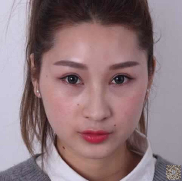 超声波瘦脸让我脸蛋小了856