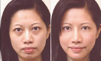 超声波祛眼袋效果明显吗？我这个体验者来告诉你139