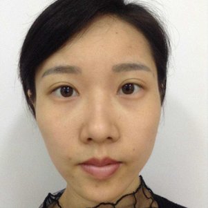 没了眼袋还是小仙女——超声波去眼袋手术433 没了眼袋还是小仙女——超声波去眼袋手术433
